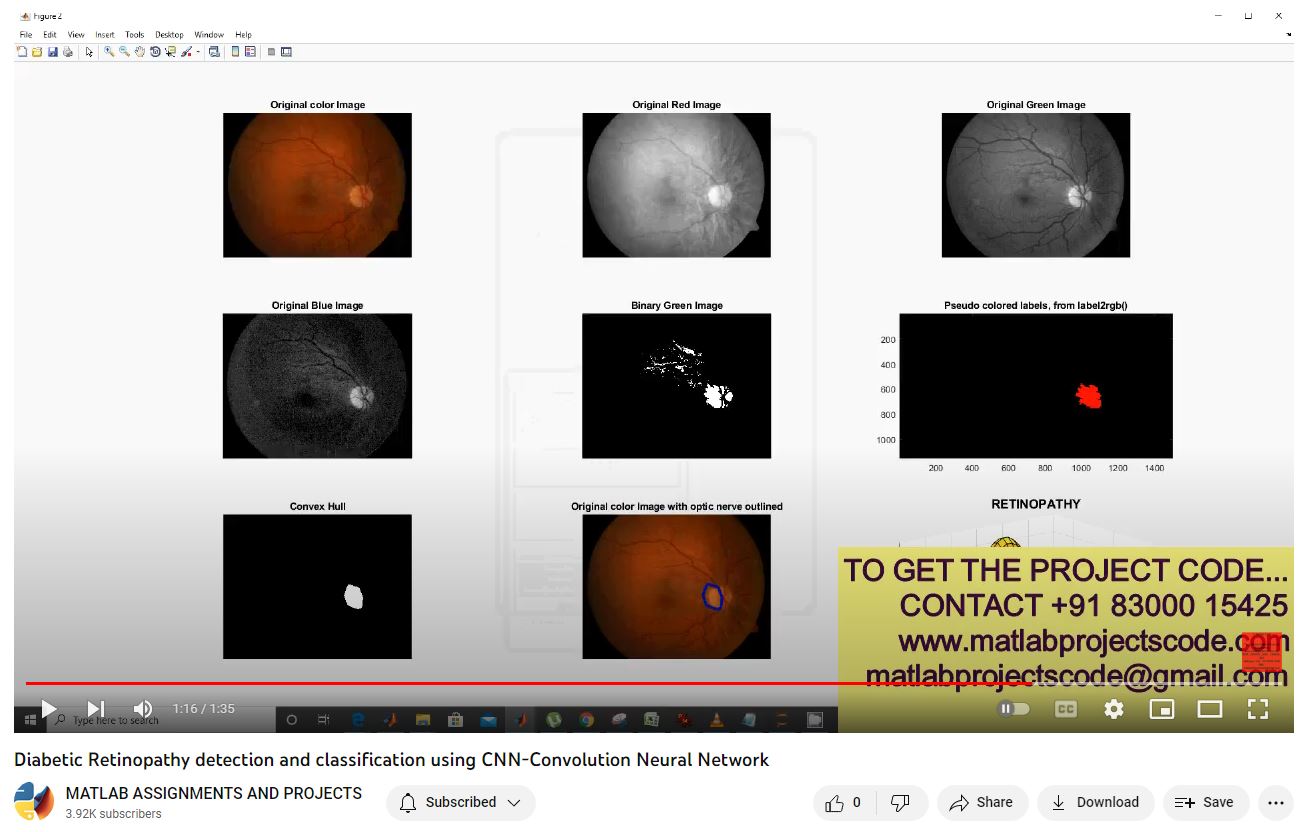 Diabetic Retinopathy Detection And Classification Using Cnn-Convolution Neural Network project simulation thumbnail for Signal Processing and AI Engineering